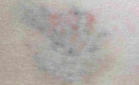 Aufgehelltes Tatoo nach Behandlung